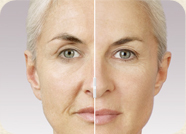 Botox & Fillers in Pune