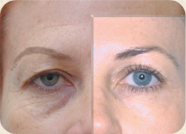 Skin Rejuvenation